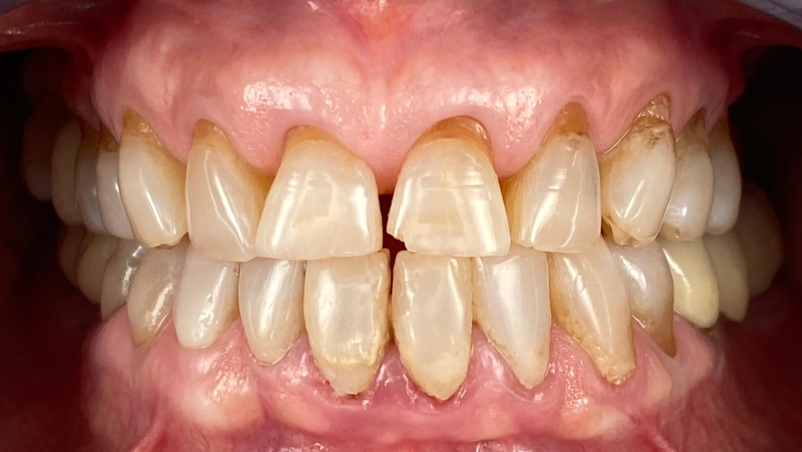 Sonrisa antes del tratamiento: forma, color y proporciones a mejorar