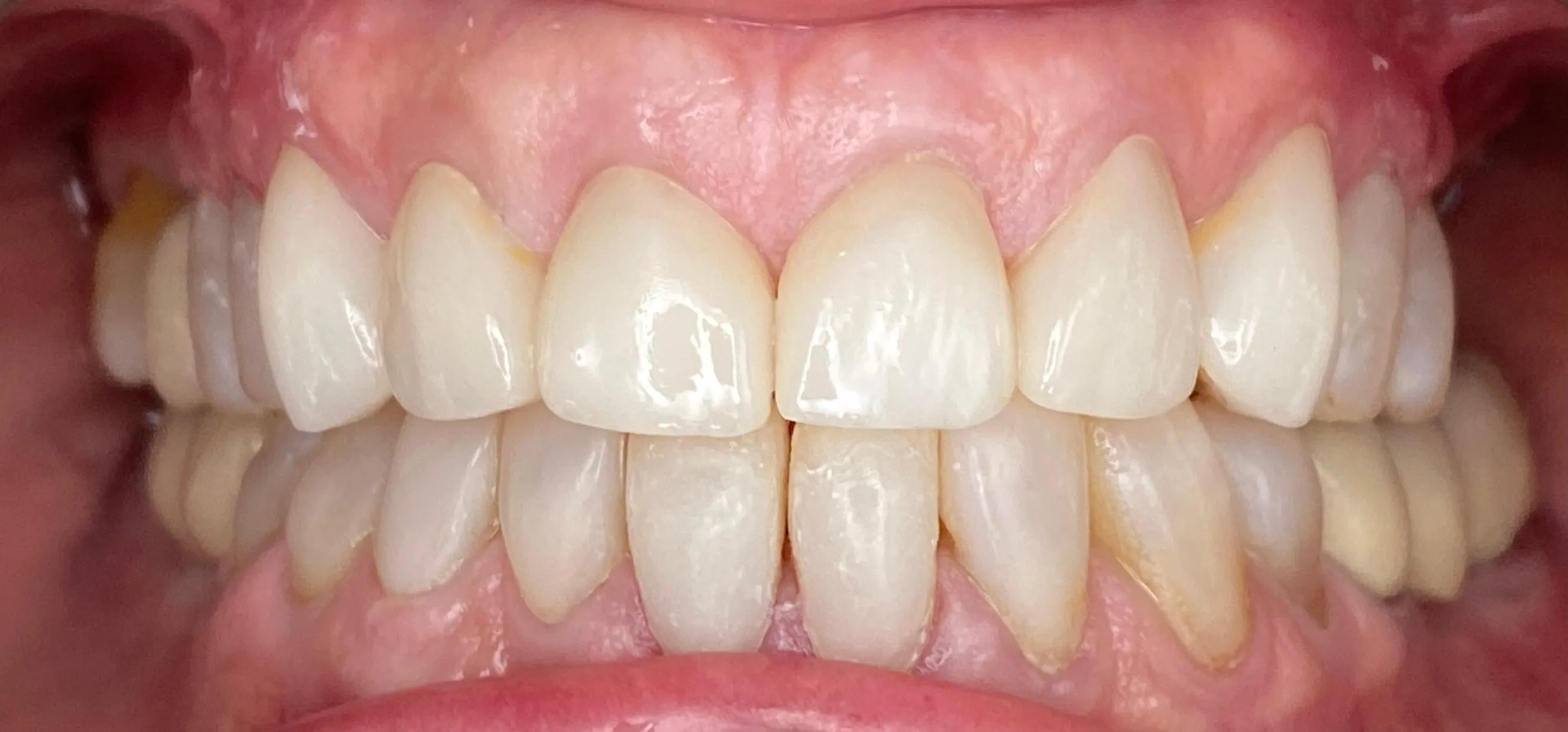 Sonrisa armónica tratada con carillas de porcelana